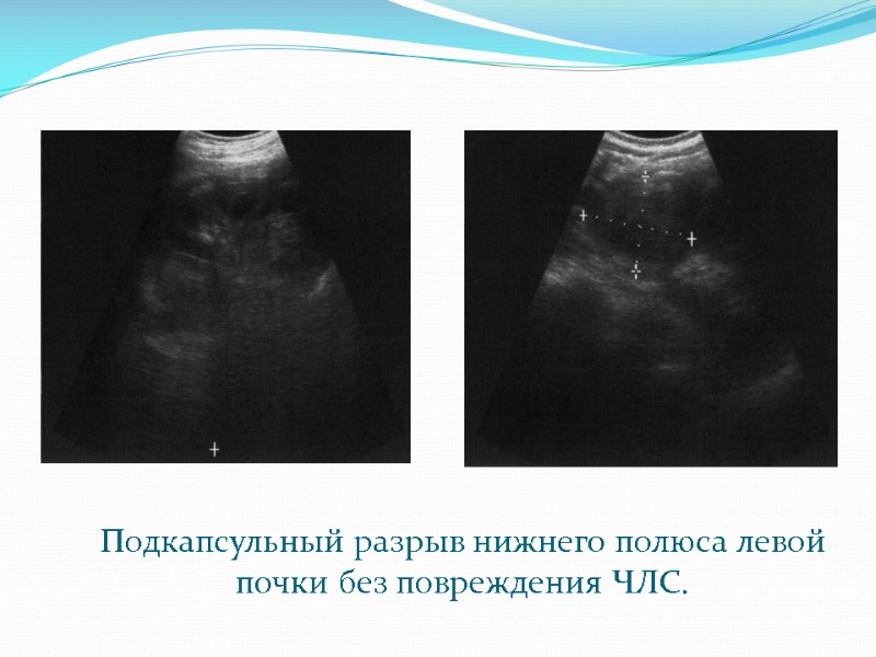 Подкапсульный разрыв нижнего полюса левой почки без повреждения ЧЛС.